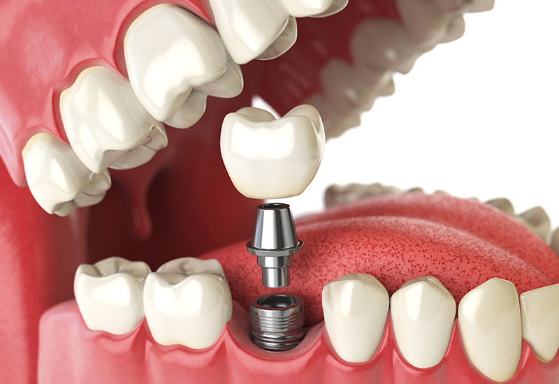 dental implants in west edmonton