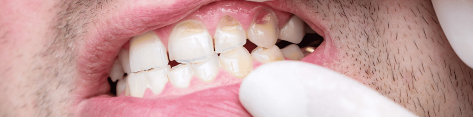 will teeth whitening damage tooth enamel