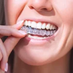 care for your invisalign